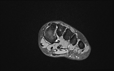 Bipartite hallux sesamoid diastasis (Radiopaedia 77133-89109 Coronal T2 fat sat 7).jpg