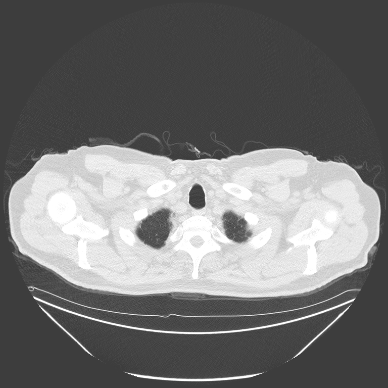 Birt-Hogg-Dubé syndrome (Radiopaedia 52578-58491 Axial lung window 3).jpg