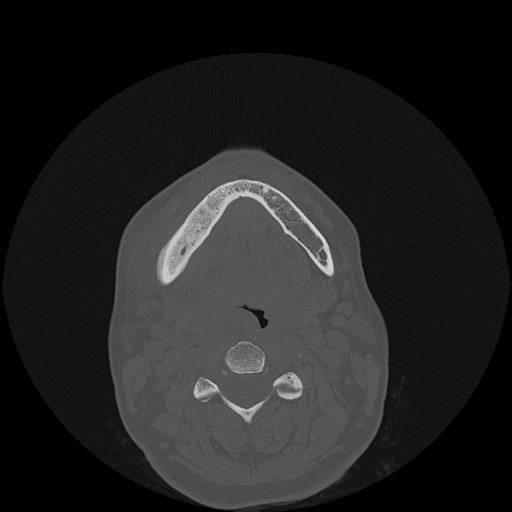 File:Bisphosphonate-related osteonecrosis of the jaw (Radiopaedia 71324-81642 Axial bone window 45).jpg