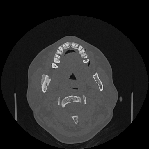 File:Bisphosphonate-related osteonecrosis of the jaw (Radiopaedia 71324-81642 Axial bone window 93).jpg