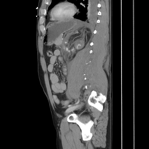 File:Blunt abdominal trauma with solid organ and musculoskelatal injury with active extravasation (Radiopaedia 68364-77895 C 94).jpg