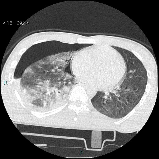Blunt chest trauma (Swiss cheese sign) (Radiopaedia 38519-40618 Axial lung window 46).jpg