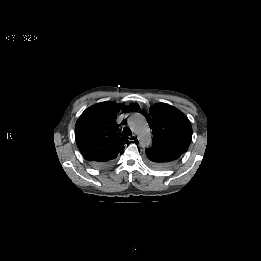 Boerhaave syndrome (Radiopaedia 27683-27897 Axial non-contrast 32).jpg