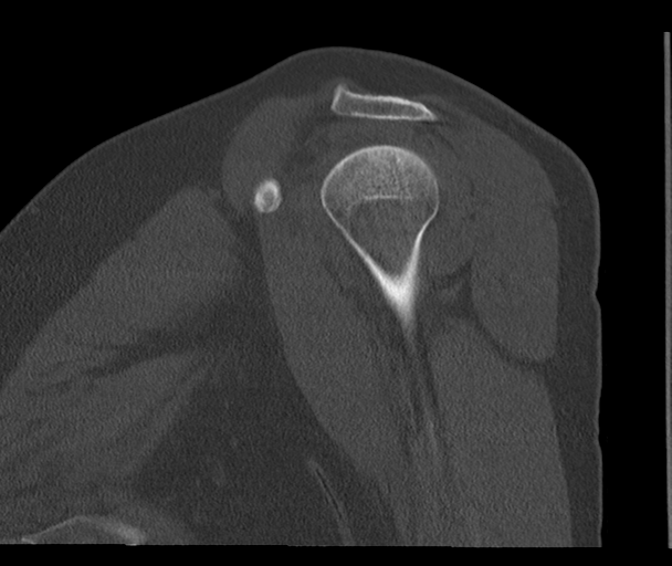 Bony Bankart and Hill-Sachs lesions (Radiopaedia 33622-34727 Sagittal bone window 24).png
