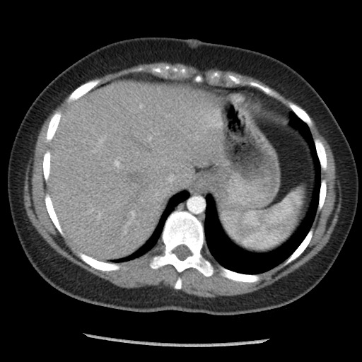 Borderline mucinous tumor (ovary) (Radiopaedia 78228-90808 A 39).jpg