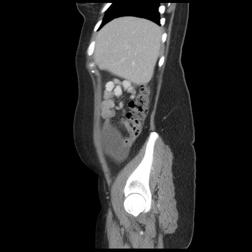 File:Borderline mucinous tumor (ovary) (Radiopaedia 78228-90808 B 17).jpg
