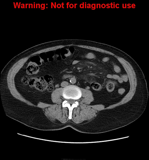 File:Bosniak renal cyst - type II (Radiopaedia 23404-23468 Axial non-contrast 24).jpg