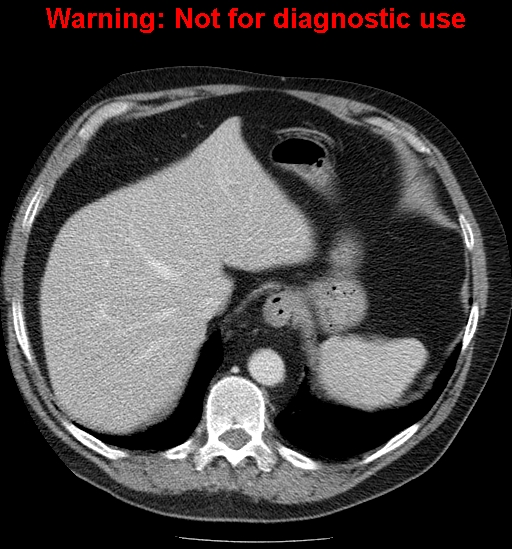 File:Bosniak renal cyst - type IV (Radiopaedia 23402-23466 D 10).jpg