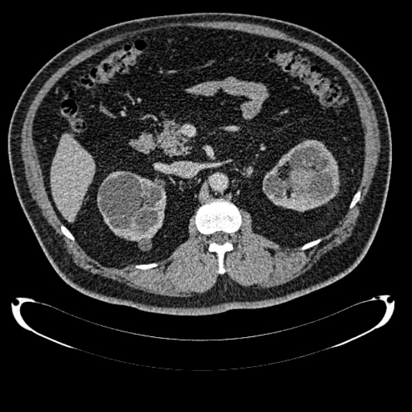 Bosniak renal cyst - type IV (Radiopaedia 24244-24518 C 129).jpg