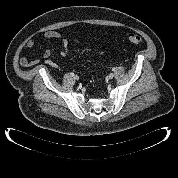Bosniak renal cyst - type IV (Radiopaedia 24244-24518 C 312).jpg