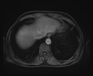 File:Bouveret syndrome (Radiopaedia 61017-68856 Axial T1 C+ fat sat 10).jpg