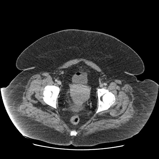 Bowel and splenic infarcts in acute lymphocytic leukemia (Radiopaedia 61055-68915 A 119).jpg