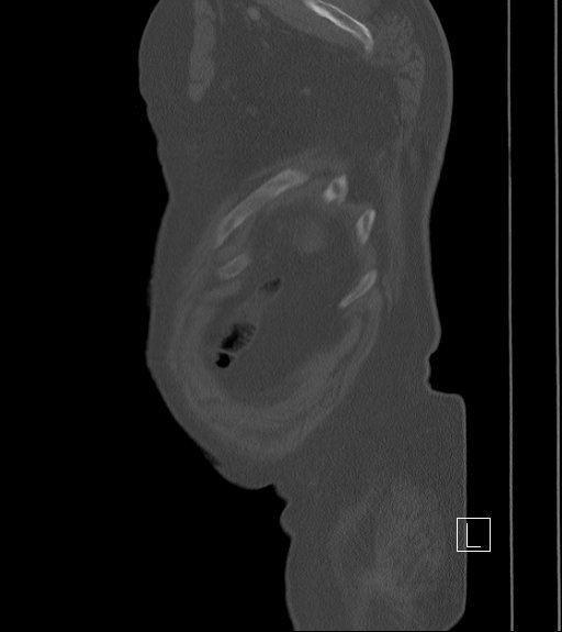 Bowel ischemia secondary to SMA occlusion with extensive portomesenteric venous gas (Radiopaedia 54656-60871 Sagittal bone window 5).jpg