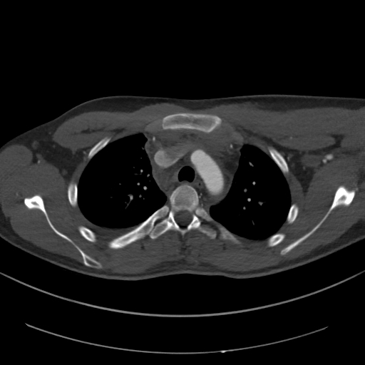 Brachiocephalic trunk pseudoaneurysm (Radiopaedia 70978-81191 Axial bone window 62).jpg