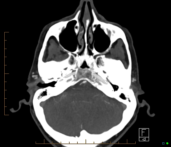 File:Brachiocephalic trunk stenosis (Radiopaedia 87242-103519 A 54).jpg