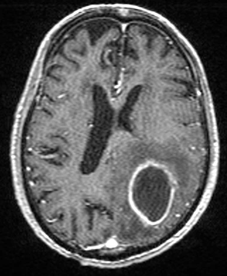 Brain abscess with dual rim sign (Radiopaedia 87566-103938 Axial T1 C+ 103).jpg