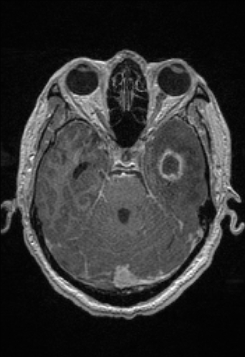 Brain abscess with ventriculitis (Radiopaedia 85703-101495 Axial T1 C+ 63).jpg