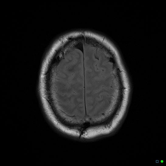 File:Brain death on MRI and CT angiography (Radiopaedia 42560-45689 Axial FLAIR 14).jpg