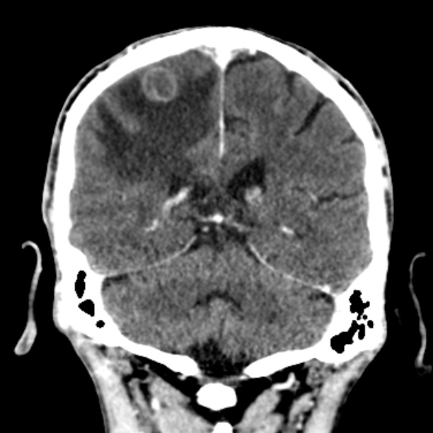 Brain metastases from lung cancer (Radiopaedia 27849-28092 Coronal C+ delayed 44).jpg