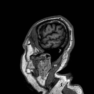Brain metastases from lung cancer (Radiopaedia 83839-99028 Sagittal T1 7).jpg