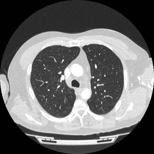 File:Brain metastases from lung cancer (Radiopaedia 83839-99030 Axial lung window 20).jpg