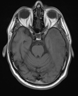 File:Brain metastasis (large cystic mass) (Radiopaedia 47497-52107 Axial T1 9).png