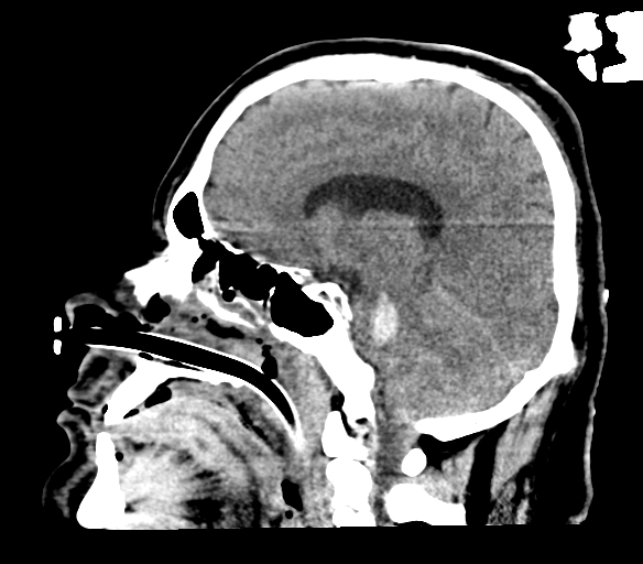 Brainstem hemorrhage (Radiopaedia 81294-94976 C 25).jpg