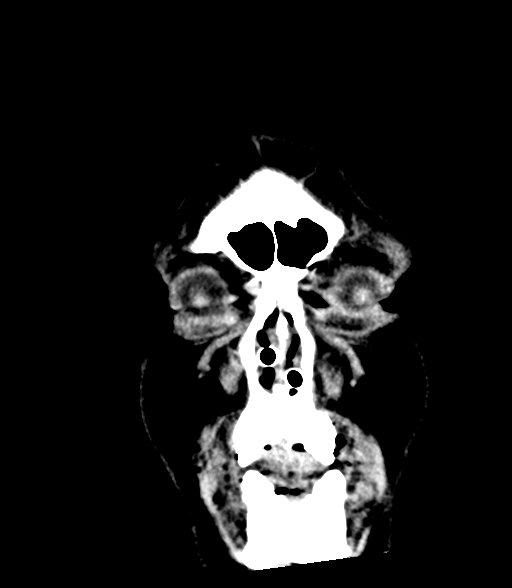 Brainstem hemorrhage (Radiopaedia 81294-94976 Coronal non-contrast 4).jpg