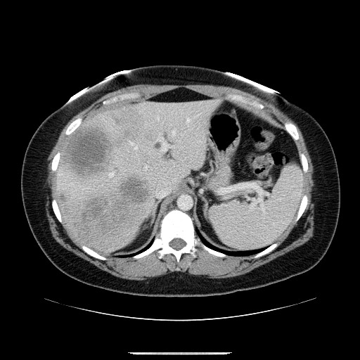File:Breast cancer pseudocirrhosis after chemotherapy (Radiopaedia 65407-74456 A 22).jpg