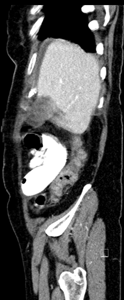 Broad ligament hernia (Radiopaedia 84802-100276 C 73).jpg