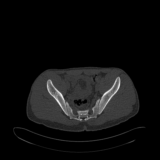 Brodie abscess- femoral neck (Radiopaedia 53862-59966 Axial bone window 82).jpg