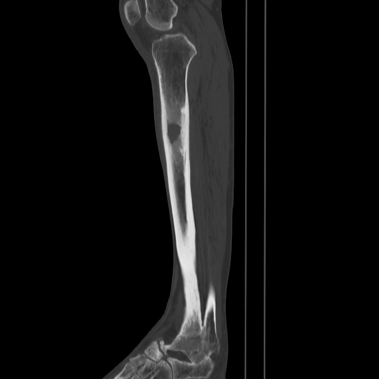 Brodie abscess - tibia (Radiopaedia 66028-75204 Sagittal bone window 36).jpg
