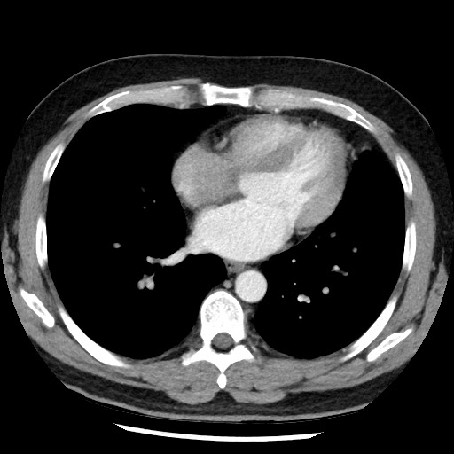Bronchial carcinoid tumor (Radiopaedia 67377-76764 A 39).jpg