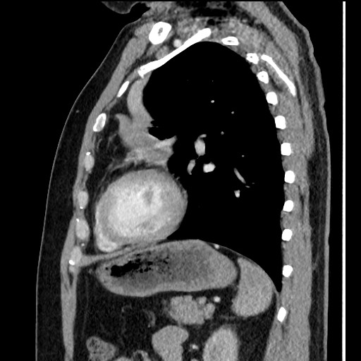 Bronchial carcinoid tumor (Radiopaedia 67377-76764 E 48).jpg