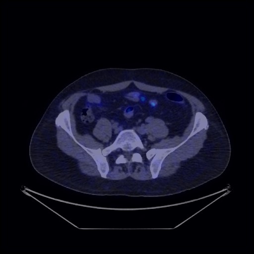 Bronchial carcinoid tumor (Radiopaedia 67377-76765 68Ga-DOTATATE PET-CT 63).jpg