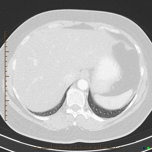 Bronchial diverticula (Radiopaedia 79512-92675 Axial lung window 43).jpg