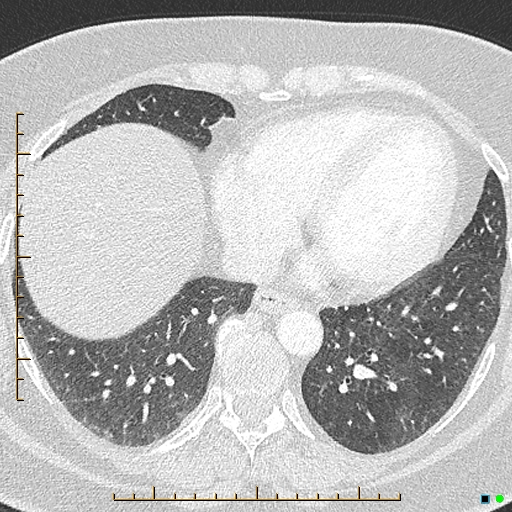 File:Bronchial diverticula (Radiopaedia 79512-92676 Axial lung window 150).jpg