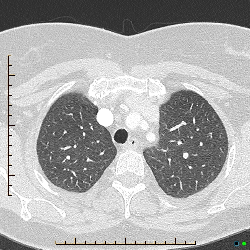 Bronchial diverticula (Radiopaedia 79512-92676 Axial lung window 34).jpg