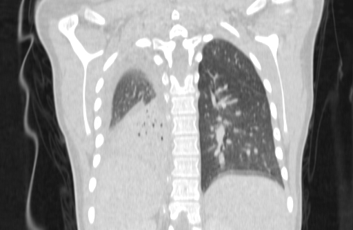 Bronchial mucoepidermoid carcinoma (Radiopaedia 57023-63895 Coronal lung window 71).jpg