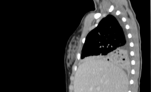 Bronchial mucoepidermoid carcinoma (Radiopaedia 57023-63895 Sagittal 45).jpg