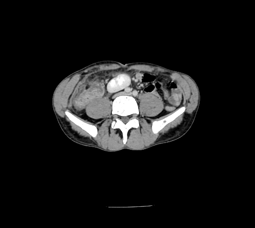 File:Bronchiectasis in Crohn disease (Radiopaedia 60311-67977 B 108).jpg