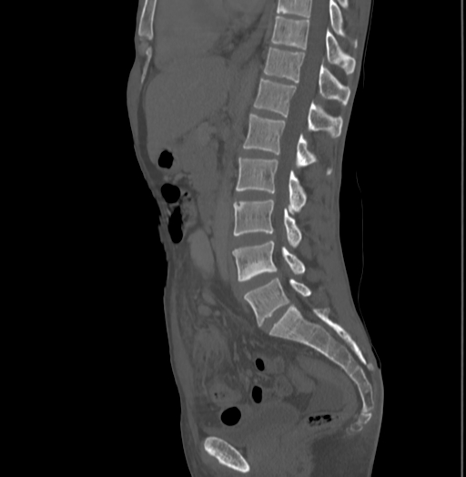 Bronchiectasis in Crohn disease (Radiopaedia 60311-67977 Sagittal bone window 129).jpg