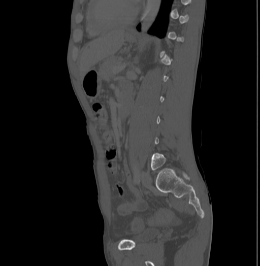 Bronchiectasis in Crohn disease (Radiopaedia 60311-67977 Sagittal bone window 158).jpg