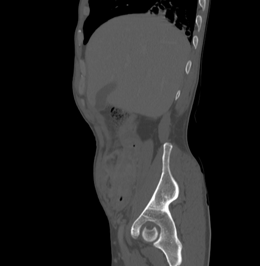 File:Bronchiectasis in Crohn disease (Radiopaedia 60311-67977 Sagittal bone window 36).jpg