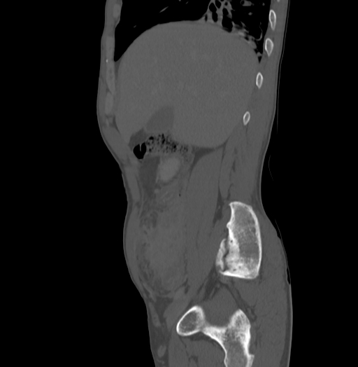 Bronchiectasis in Crohn disease (Radiopaedia 60311-67977 Sagittal bone window 54).jpg