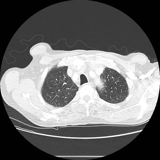 File:Bronchocele (Radiopaedia 17097-16795 Axial lung window 23).jpg
