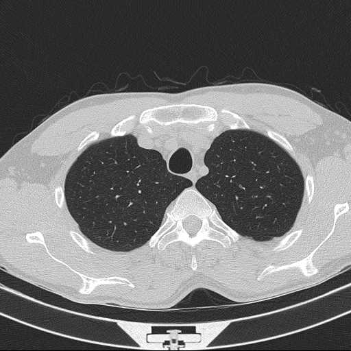 Bronchocele (Radiopaedia 60676-68429 Axial lung window 12).jpg