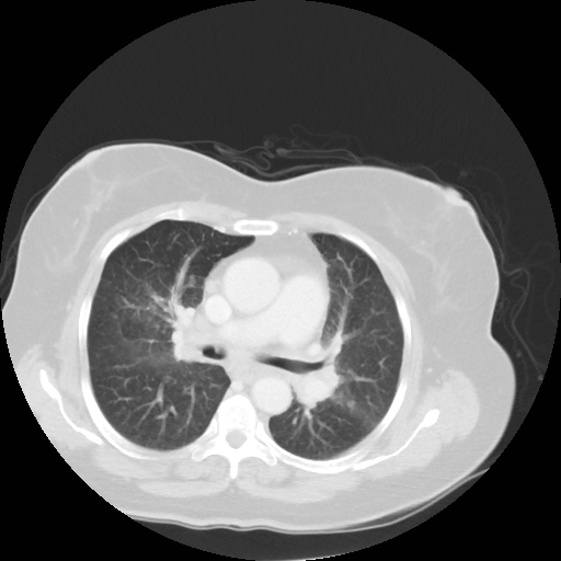 Bronchogenic carcinoma (Radiopaedia 73497-84262 Axial lung window 32).jpg