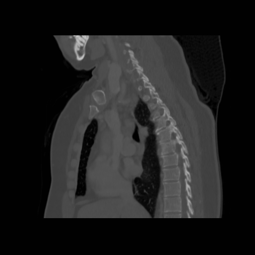Bronchogenic carcinoma (Radiopaedia 73497-84262 Sagittal bone window 75).jpg