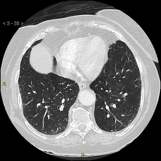Bronchogenic carcinoma as an incidental finding (Radiopaedia 16453-16130 Axial lung window 38).jpg